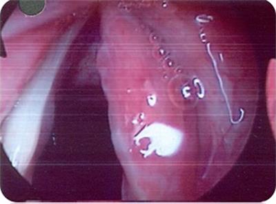 Laryngeal Cryptococcosis Associated With Inhaled Corticosteroid Use: Case Reports and Literature Review